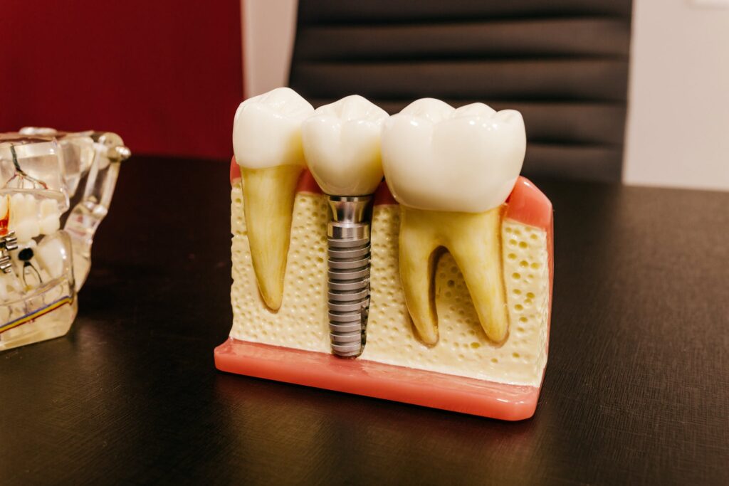 Wie funktionieren Zahnimplantate?